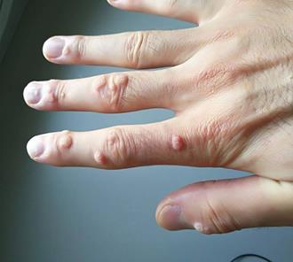 cum scapi de negi rapid