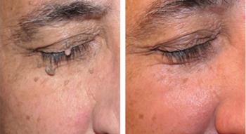 indepartare papiloame acasa