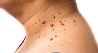 tratament naturist papiloame