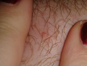 tratament negi genitali